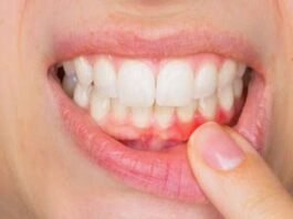 bleeding-gums-problem