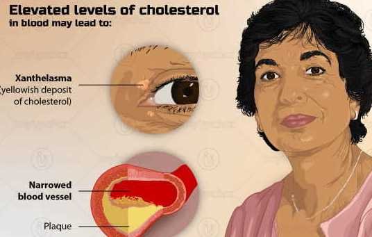 high-cholesterol-symptoms